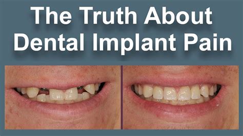 cheapest way to get dental implants